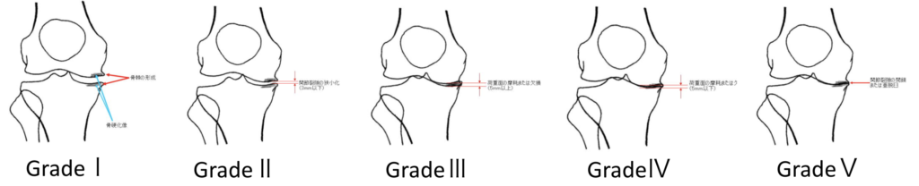 変形性膝関節症のグレード