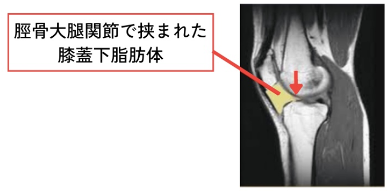 脛骨大腿関節で挟まれた膝蓋下脂肪体のMRI画像
