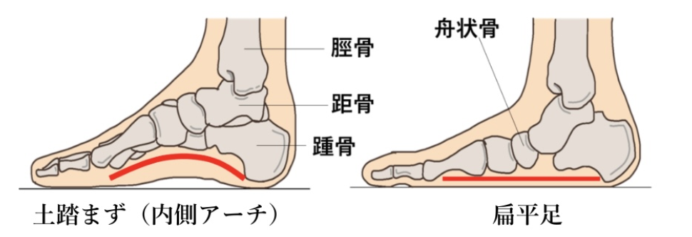 扁平足の足部について